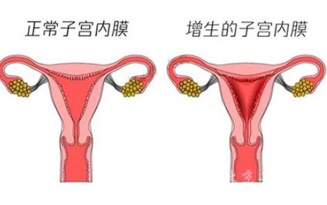 子宮內膜增生